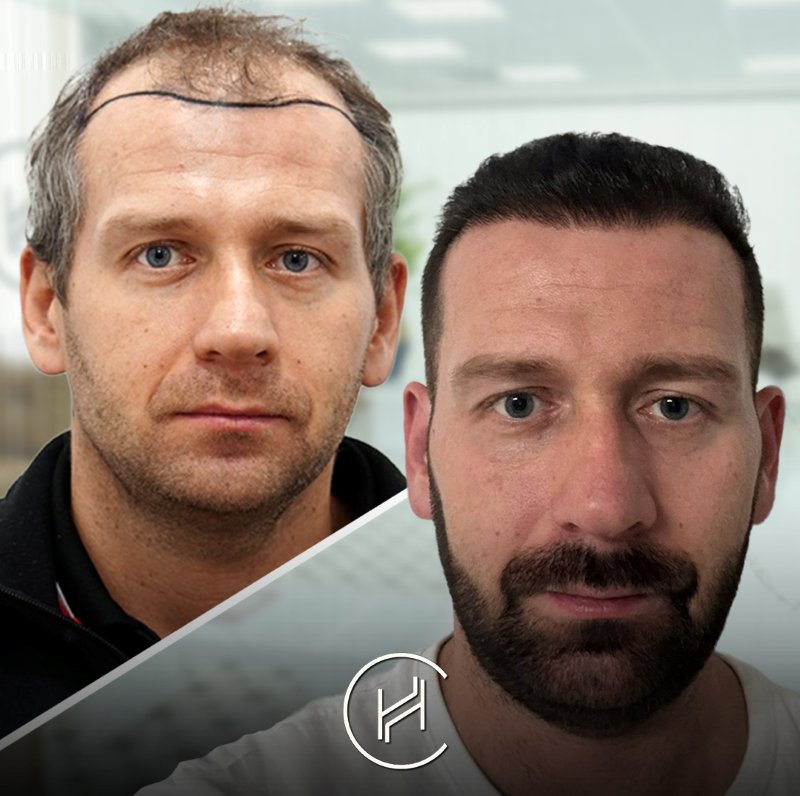 Haartransplantation vor und nach der Heva Clinic Türkei