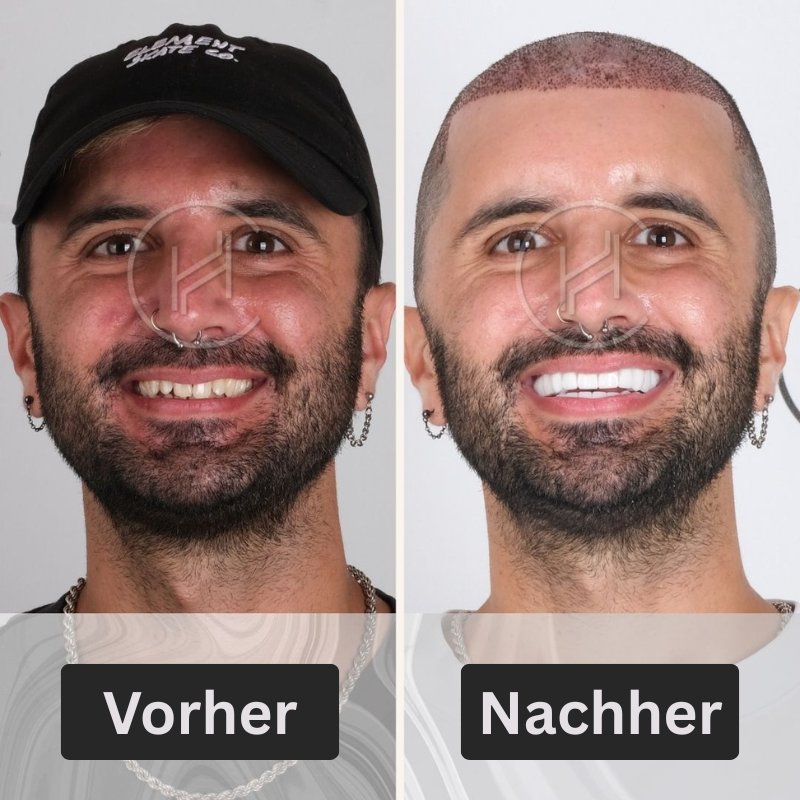 Hevadent Smile Makeover Dental -Verfahren vor und nach Istanbul