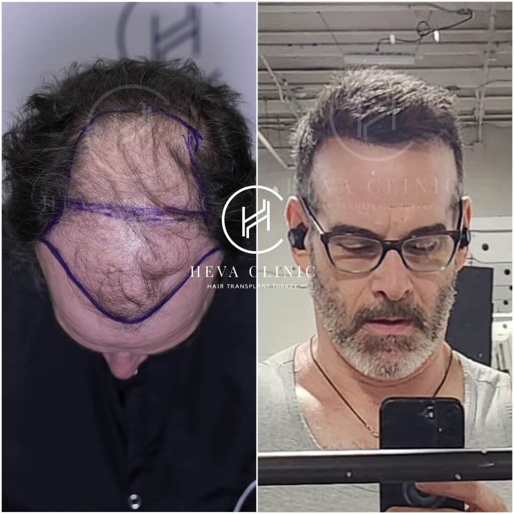 Kahlheit Haartransplantation vor und nach Ergebnis