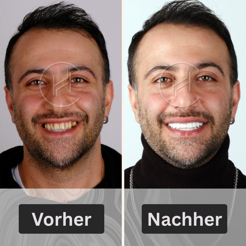 Männliches Veneer Smile Makeover führt in der Türkei in Hevadent