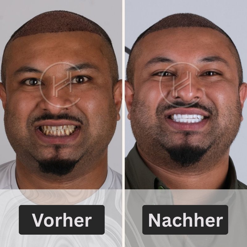 Smile Makeover Vorher und nachher Türkei Istanbul