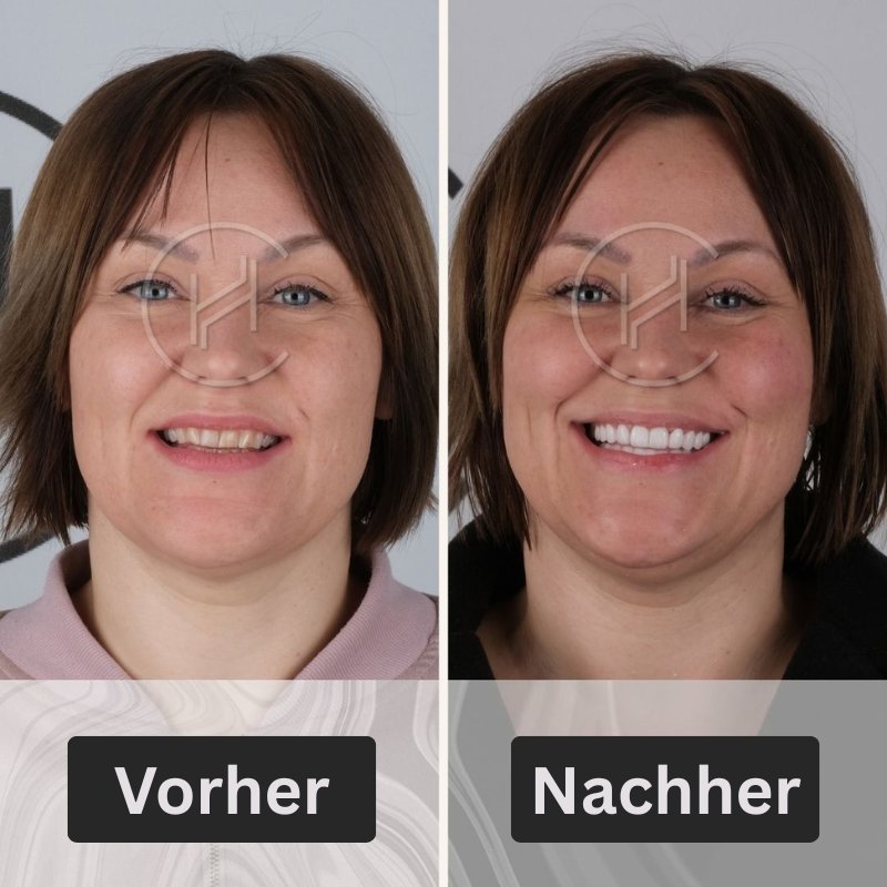 Smile Makeover in Hevadent Istanbul Türkei