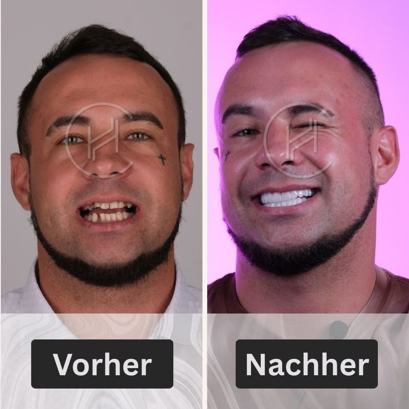 Smile Makeover in der Türkei vor und nach Ergebnis