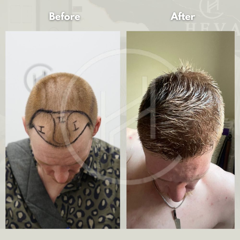 Transplantation bei blonden Haaren - Kosten in 2026 - Heva Clinic