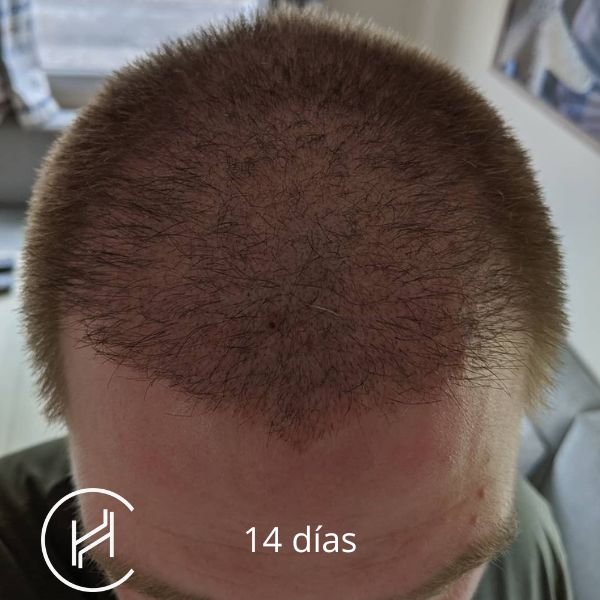 14 días después del trasplante de pelo