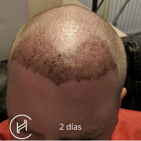 2 días después del trasplante de pelo