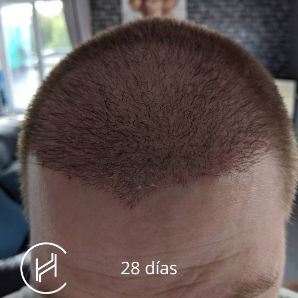 28 días después del trasplante de pelo