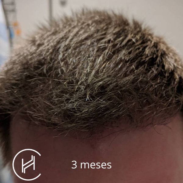 3 meses después del trasplante de pelo