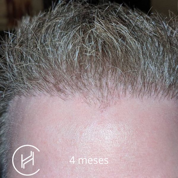 4 meses después del trasplante de pelo