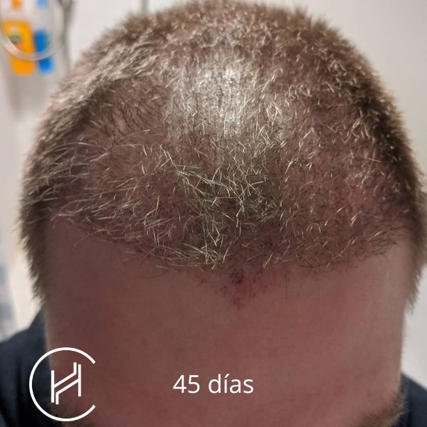 45 días después del trasplante de pelo