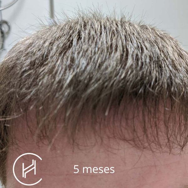 5 meses después del trasplante de pelo