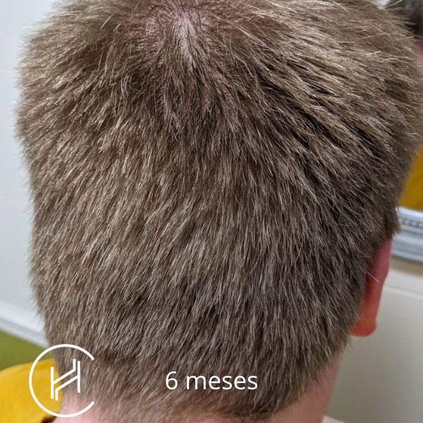 6 meses después del trasplante de pelo - donor