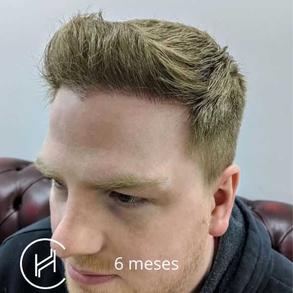 6 meses después del trasplante de pelo