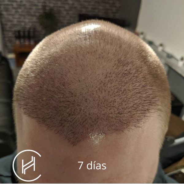 7 días después del trasplante de pelo