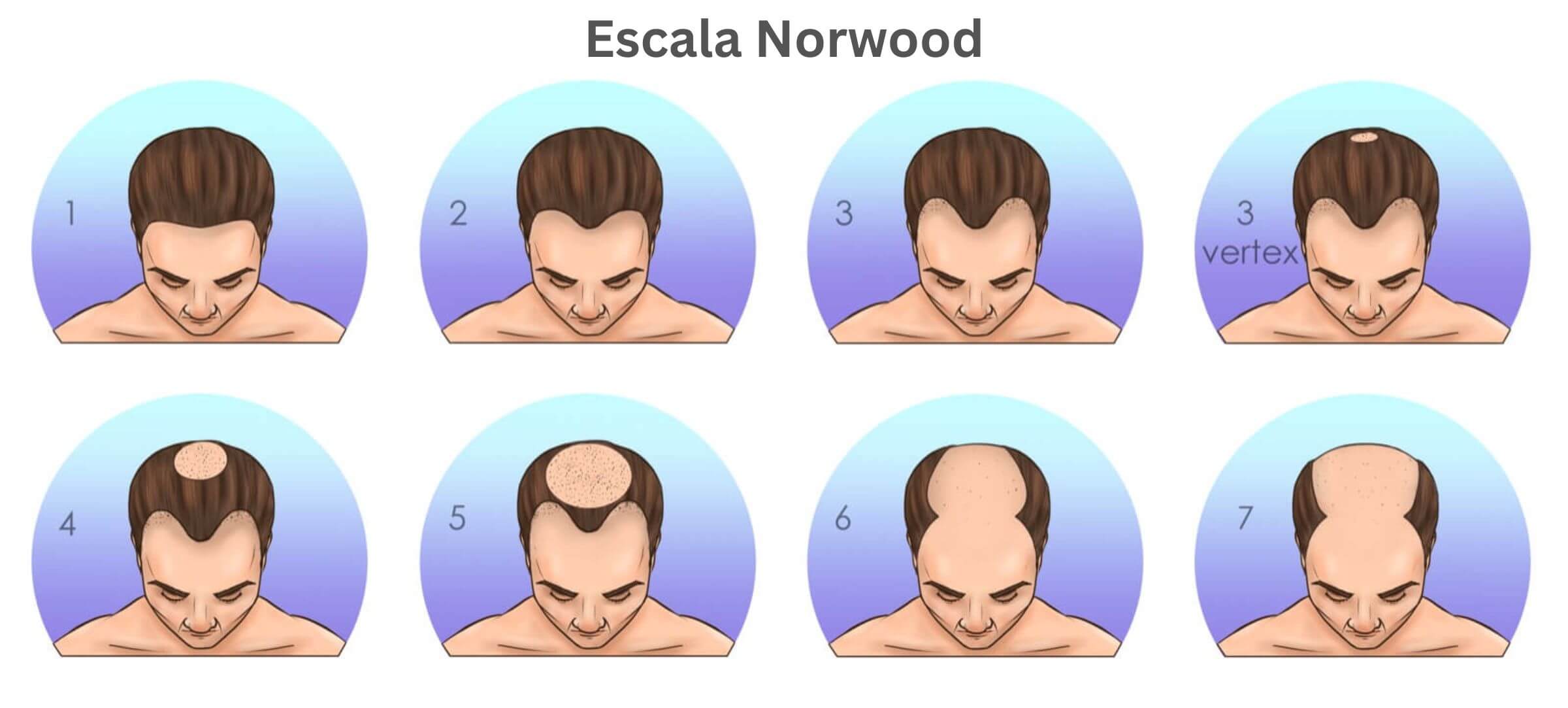 Escala Norwood - Cuántos unidades foliculares necesito