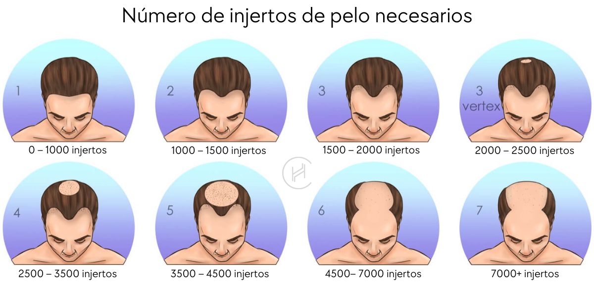 Número de injertos de pelo necesarios