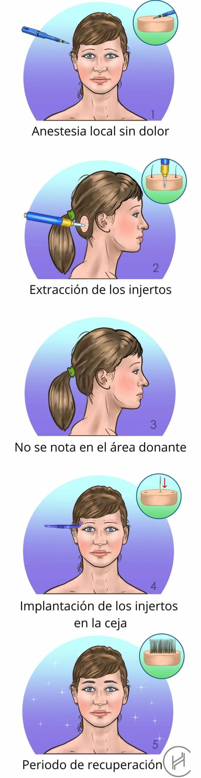Tratamiento del trasplante de cejas pasos