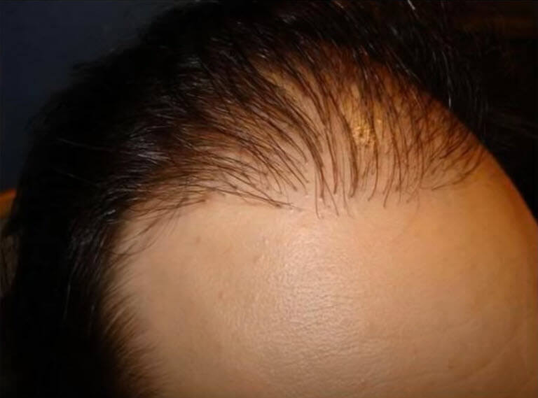 cabello fino después del trasplante de cabello