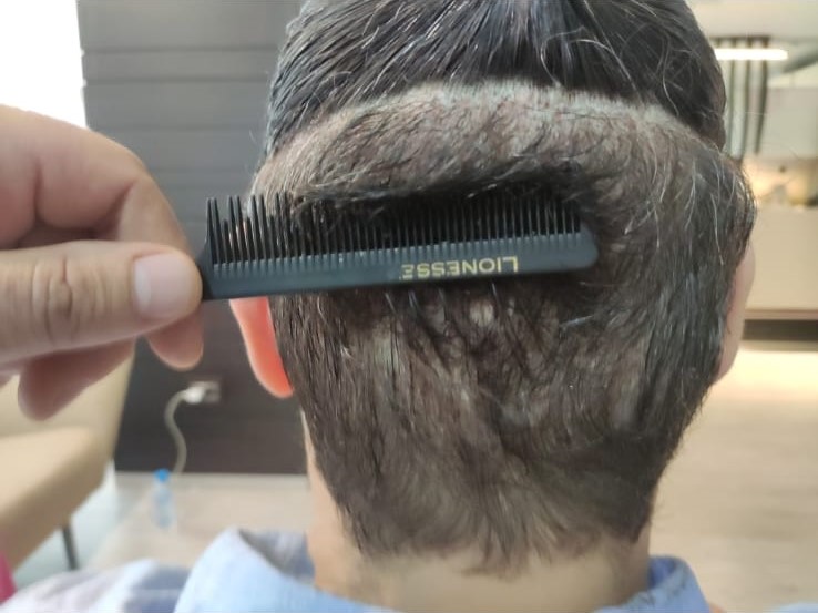 completamente sin cortar pelo trasplante de cabello zona donante