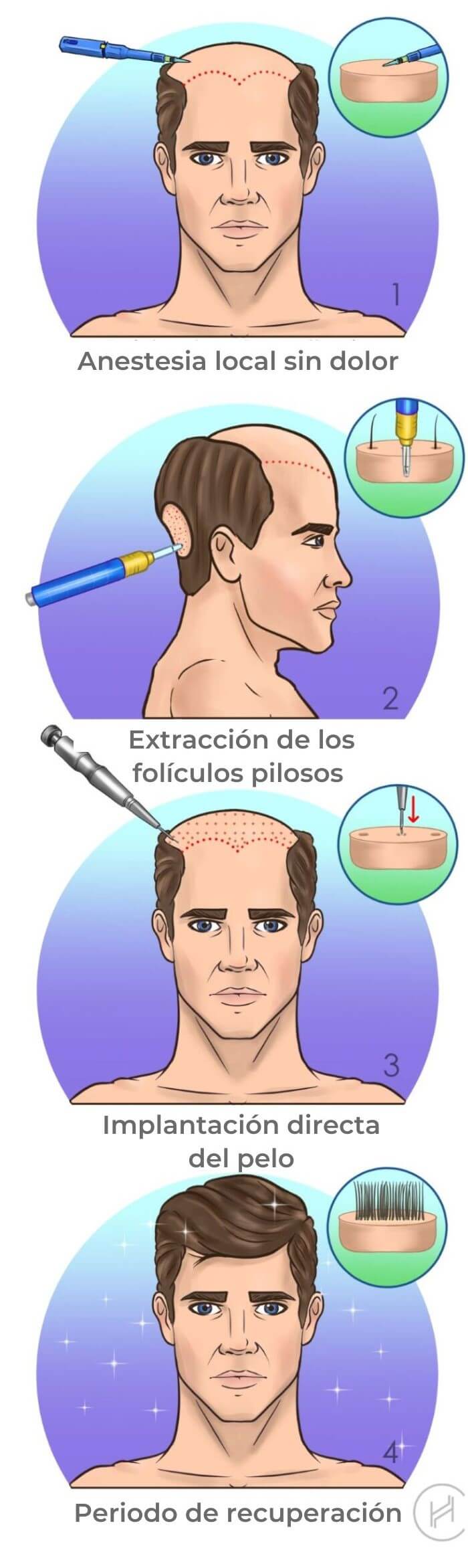 dhi-transplante-de-cabello-operacion-pasos