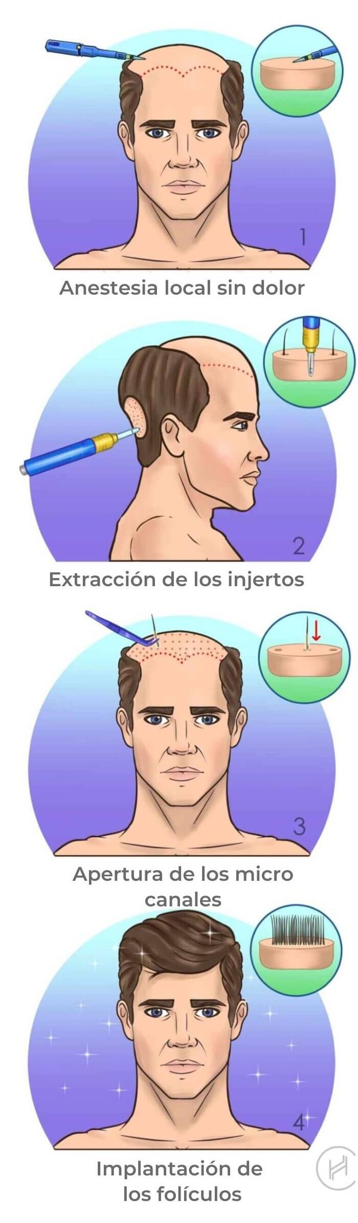 fue-trasplante-de-cabello-operacion-pasos fue-trasplante-de-cabello-operacion-pasos