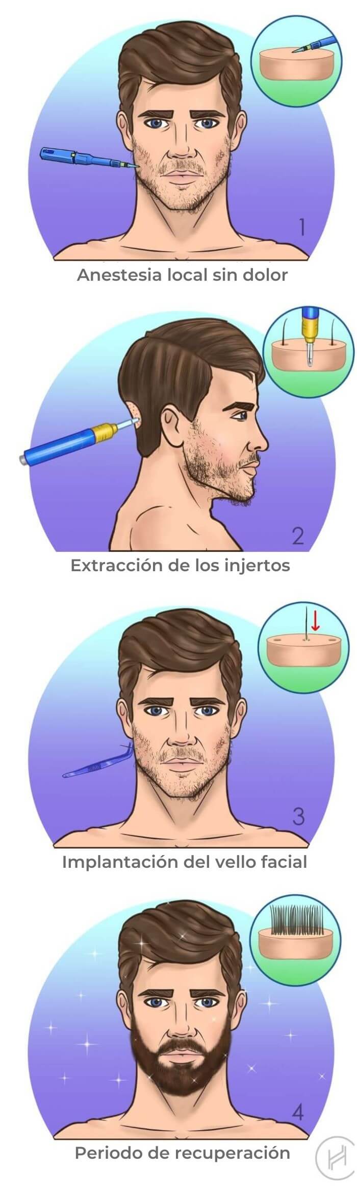 pasos de la operación de trasplante de barba