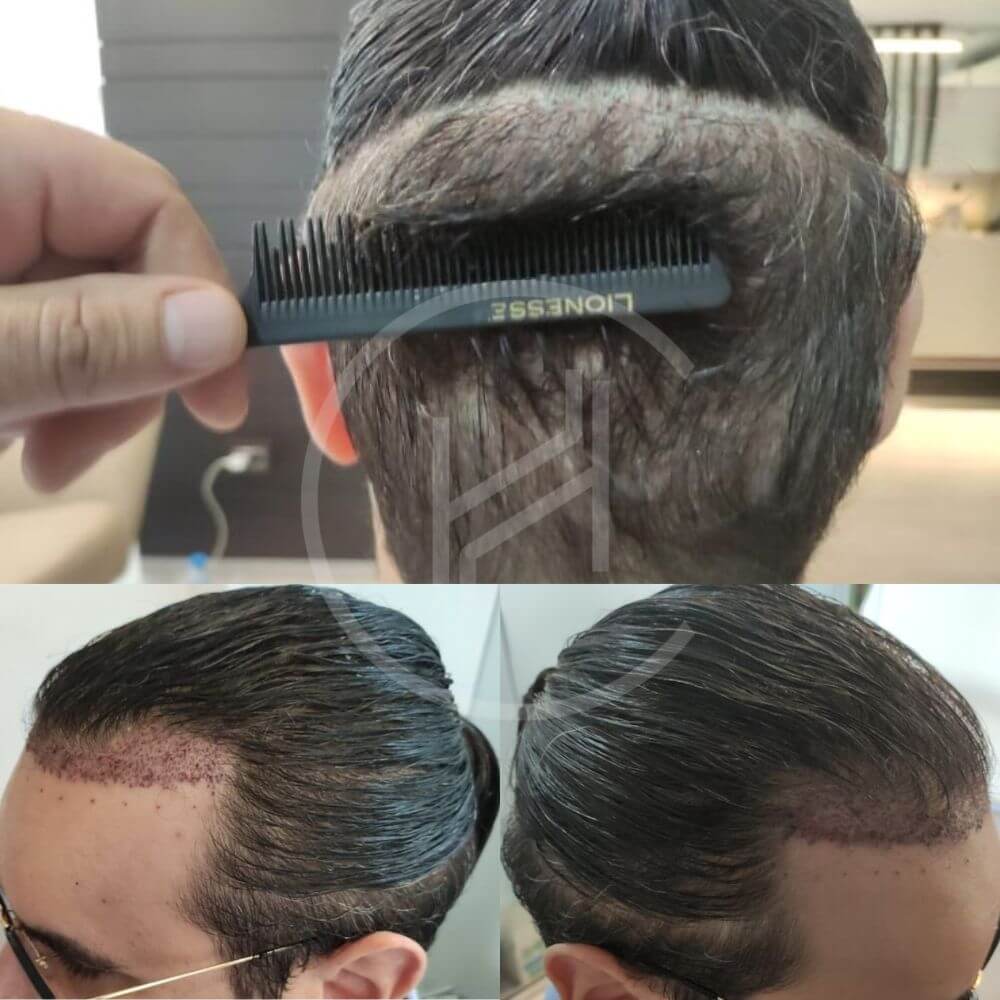 trasplante capilar sin cortar el pelo