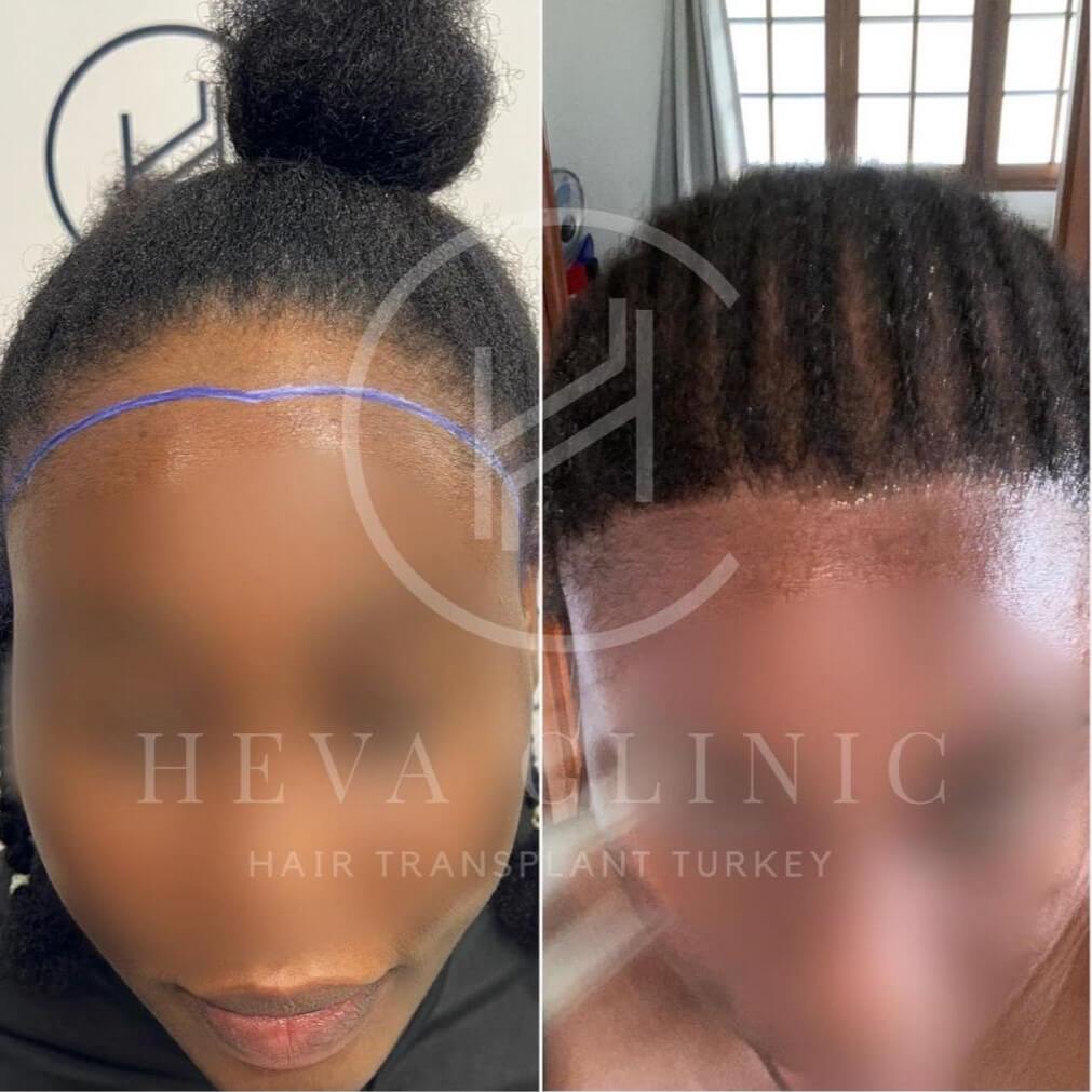 trasplante de cabello mujer rizado afro turquía clínica heva