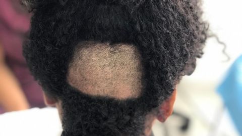 zona donante Trasplante de pelo para mujeres