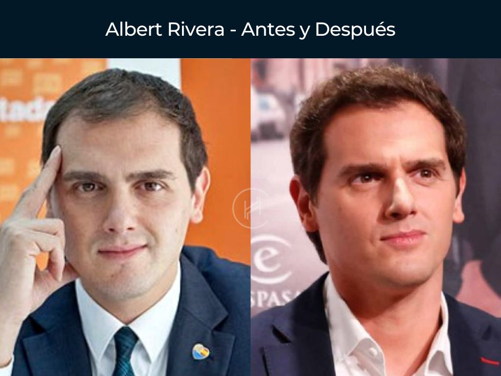 Albert Rivera - Antes y Después Injerto Capilar