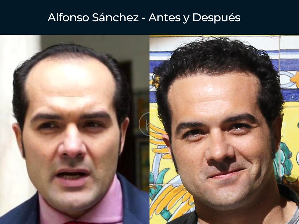 Alfonso Sánchez - Antes y Después Injerto Capilar