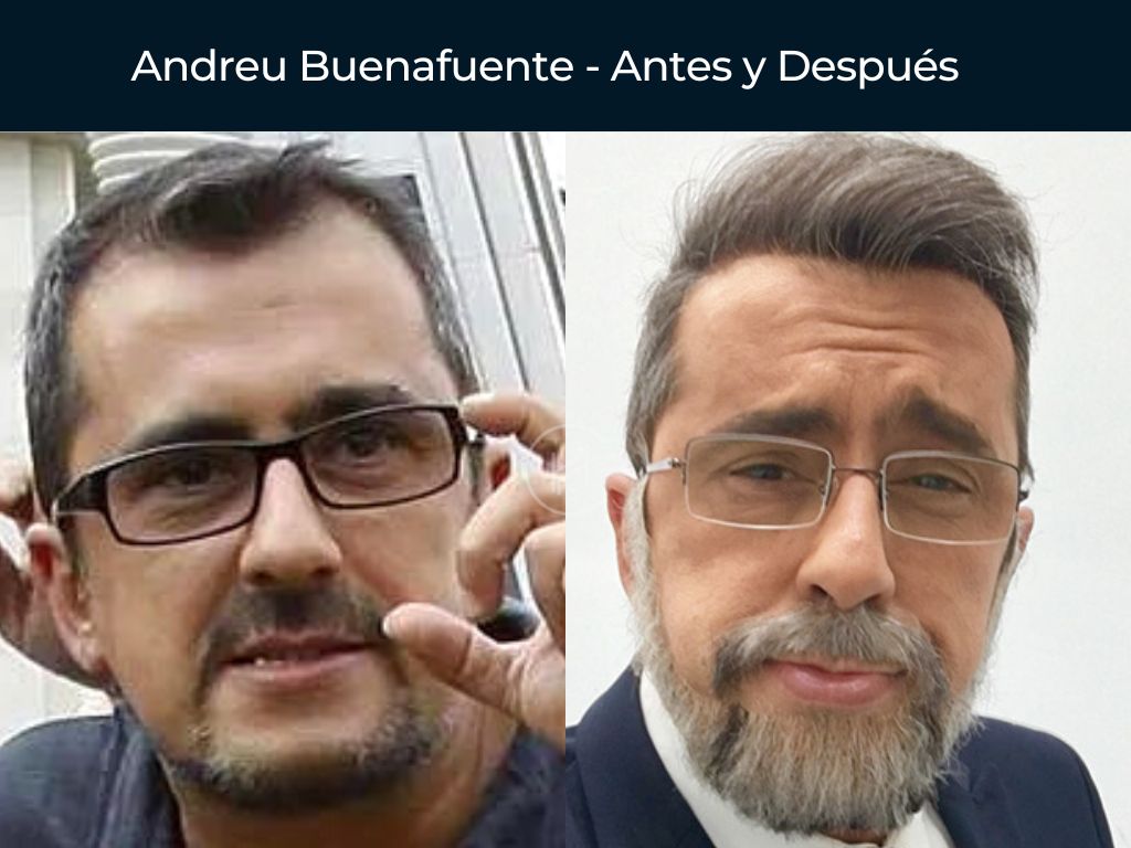 Andreu Buenafuente - Antes y Después Injerto Capilar
