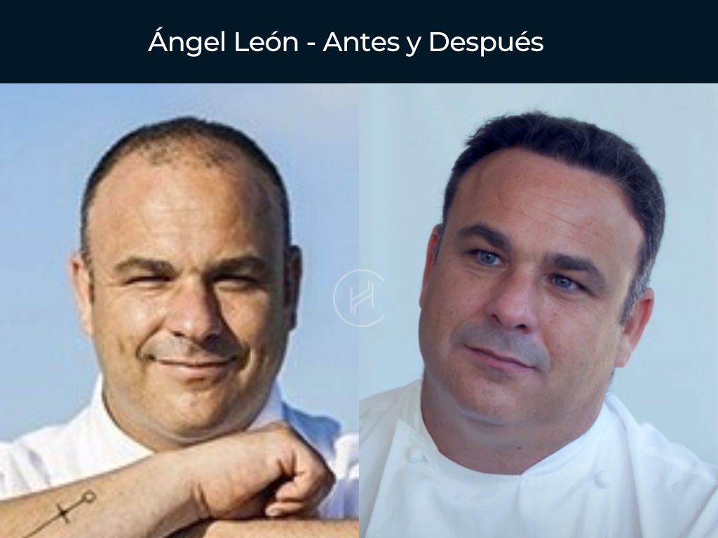 Ángel León - Antes y Después Injerto Capilar