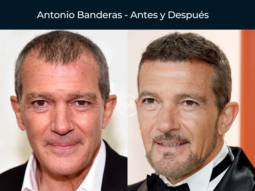 Antonio Banderas - Antes y Después Injerto Capilar