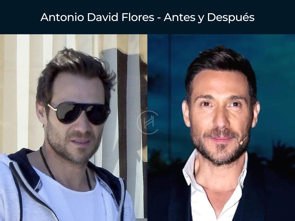 Antonio David Flores - Antes y Después Injerto Capilar