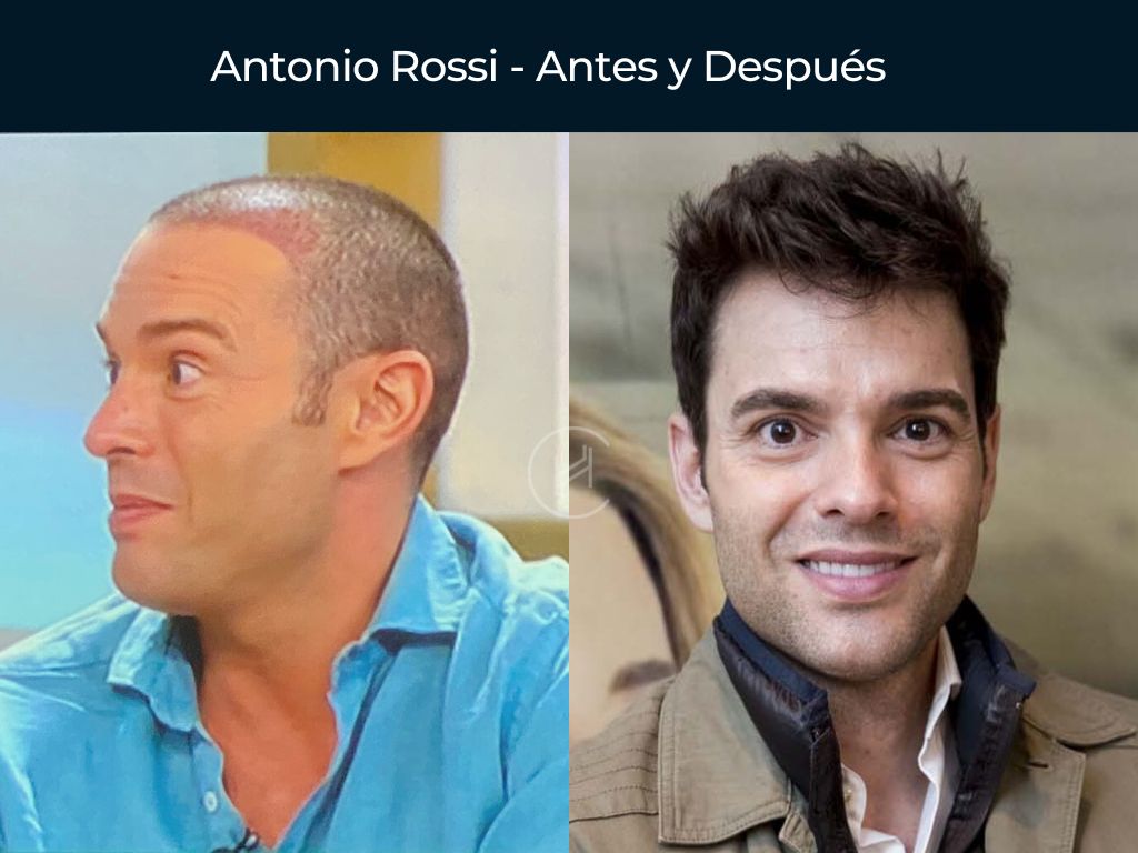 Antonio Rossi - Antes y Después Injerto Capilar