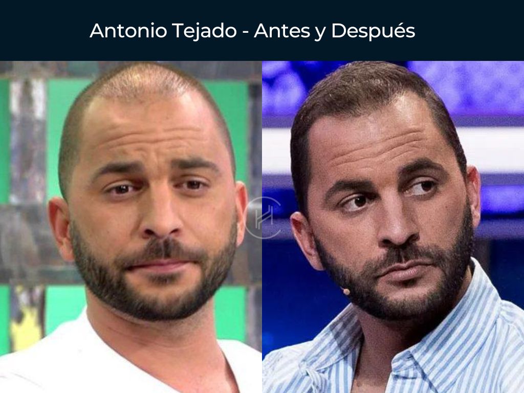 Antonio Tejado - Antes y Después Injerto Capilar