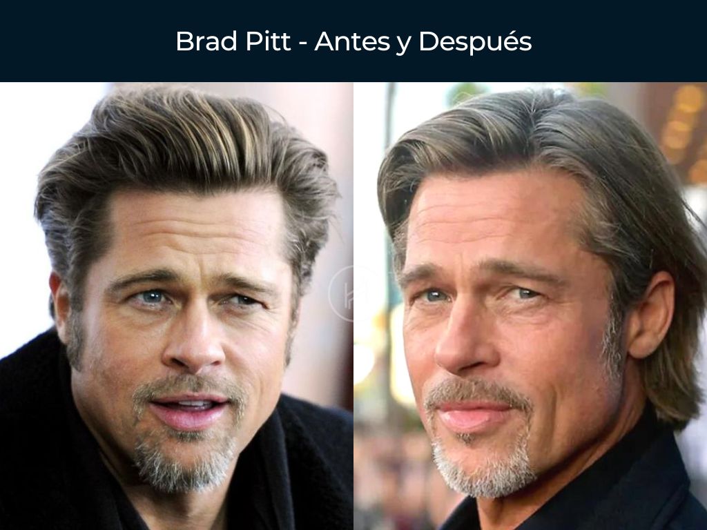 Brad Pitt - Antes y Después Injerto Capilar
