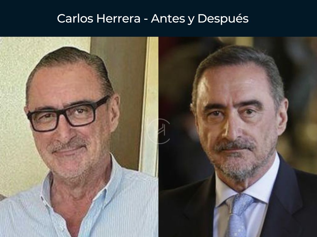 Carlos Herrera - Antes y Después Injerto Capilar