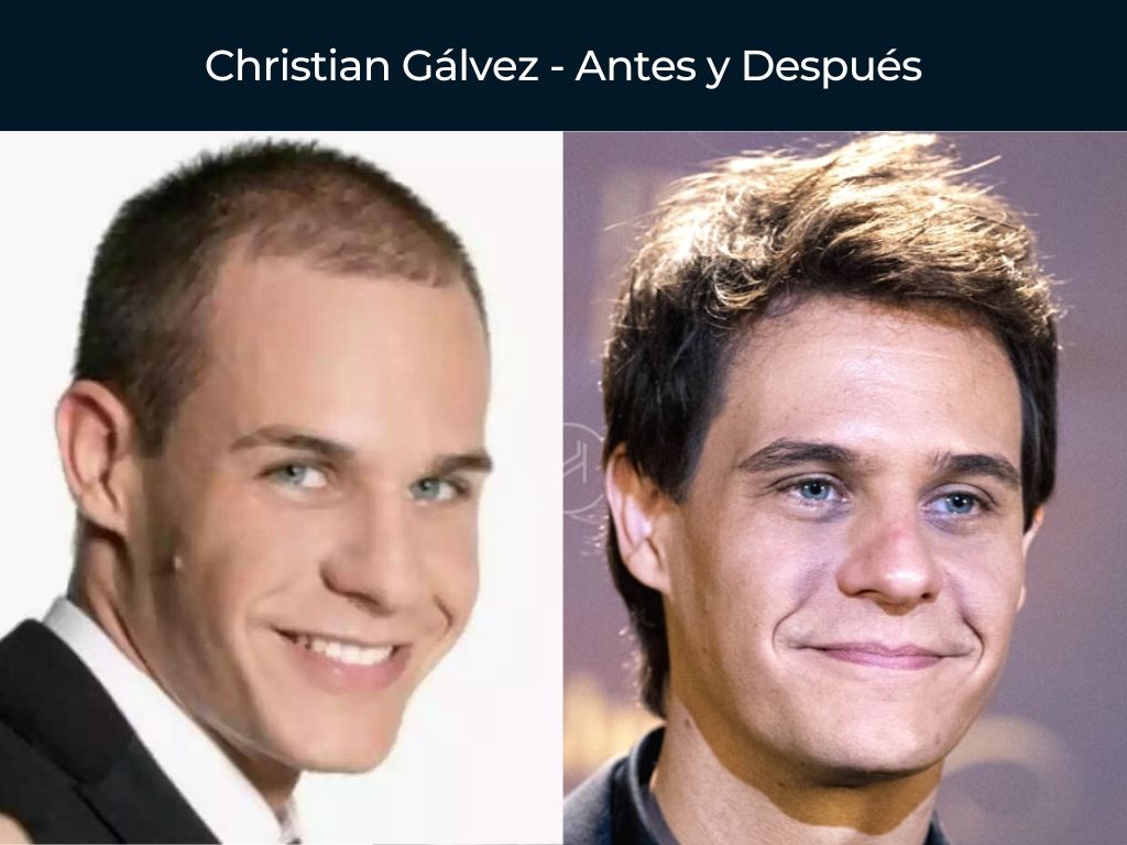 Christian Gálvez - Antes y Después Injerto Capilar
