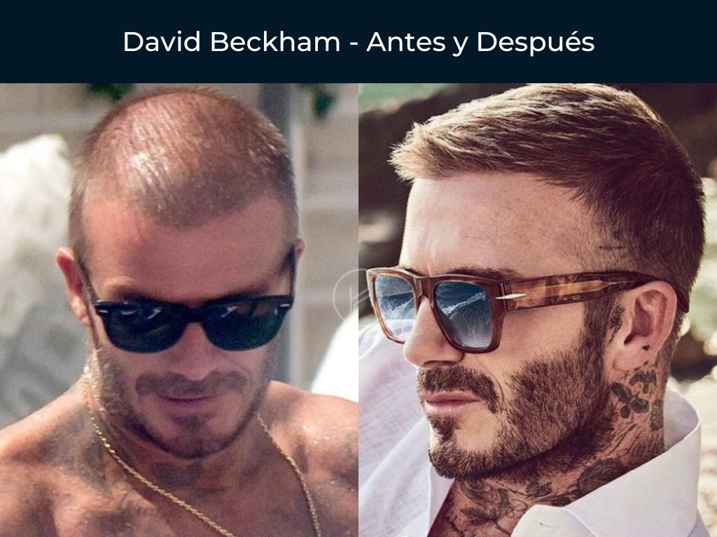 David Beckham - Antes y Después Injerto Capilar