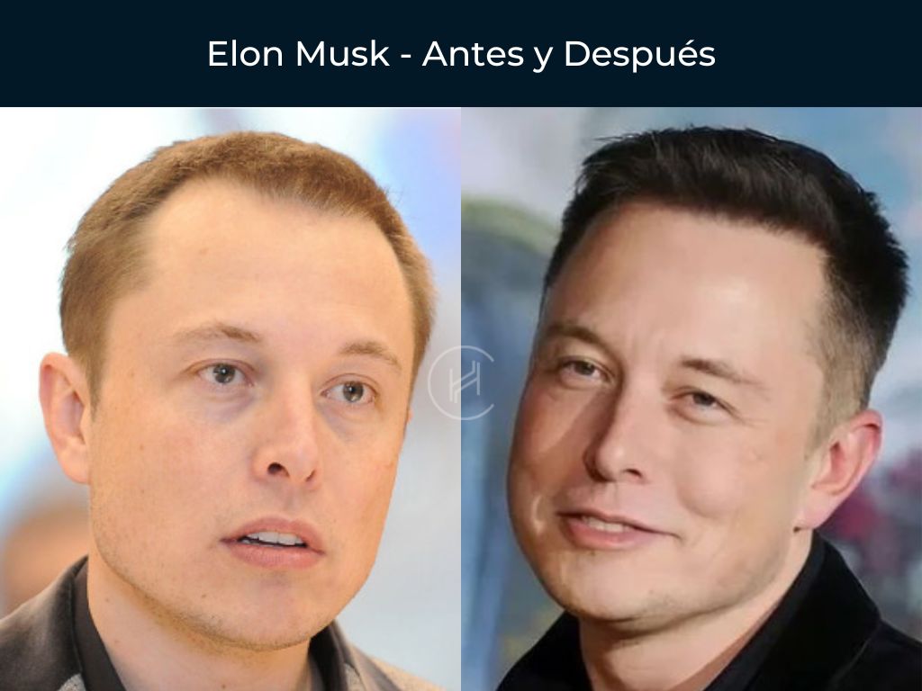 Elon Musk - Antes y Después Injerto Capilar