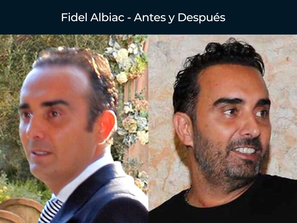 Fidel Albiac - Antes y Después Injerto Capilar