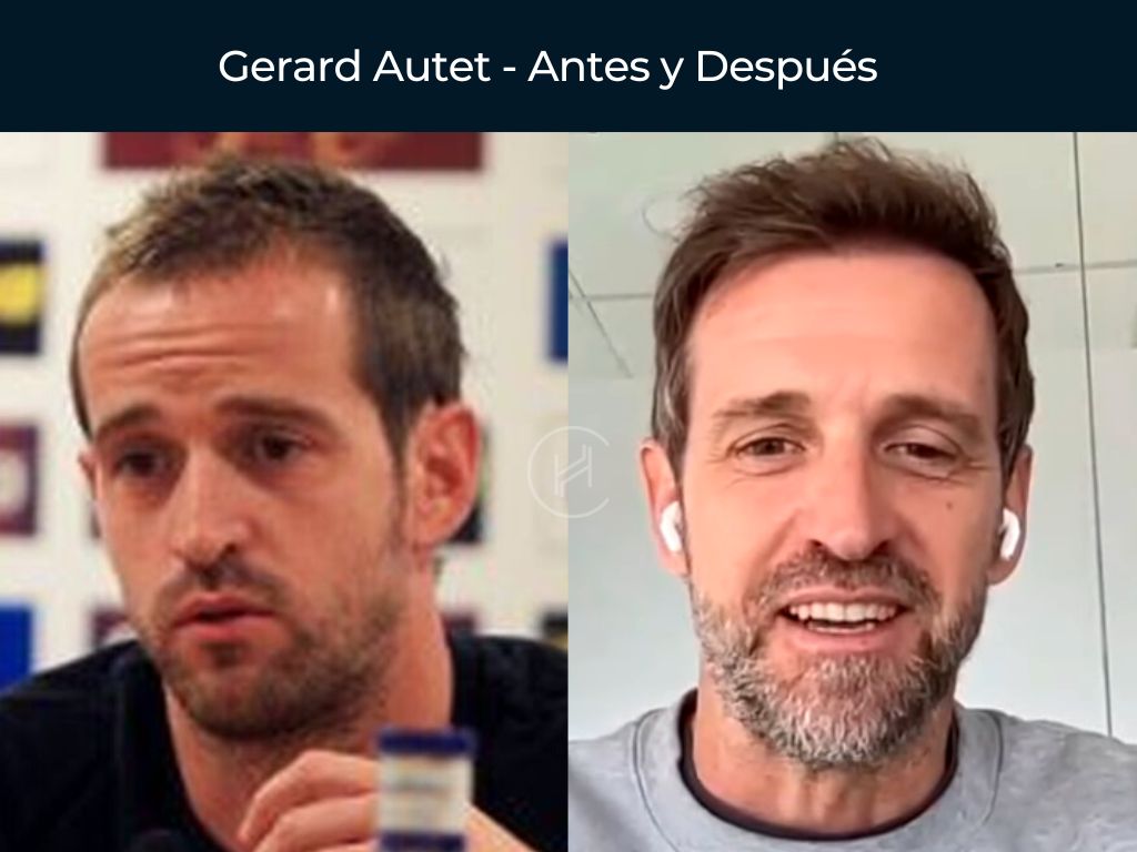 Gerard Autet - Antes y Después Injerto Capilar
