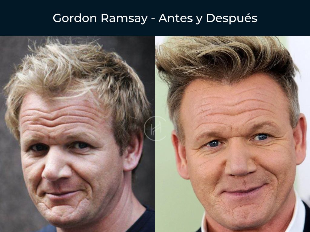 Gordon Ramsay - Antes y Después Injerto Capilar