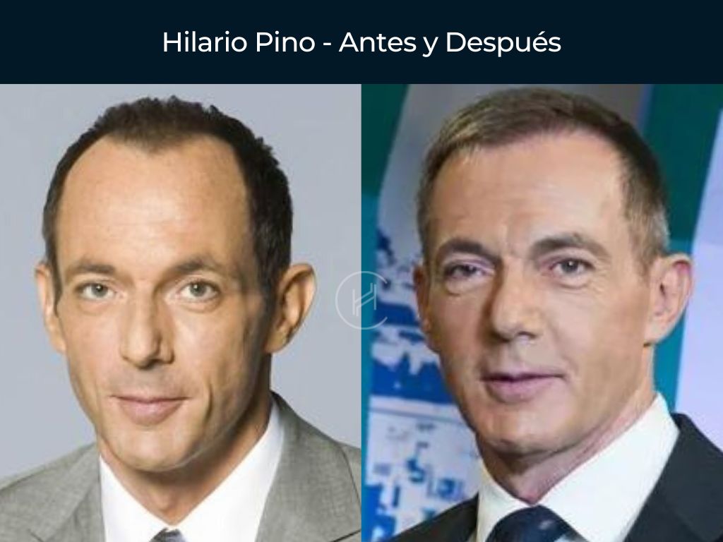 Hilario Pino - Antes y Después Injerto Capilar