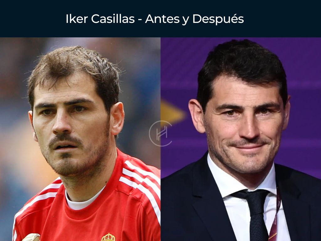 Iker Casillas - Antes y Después Injerto Capilar