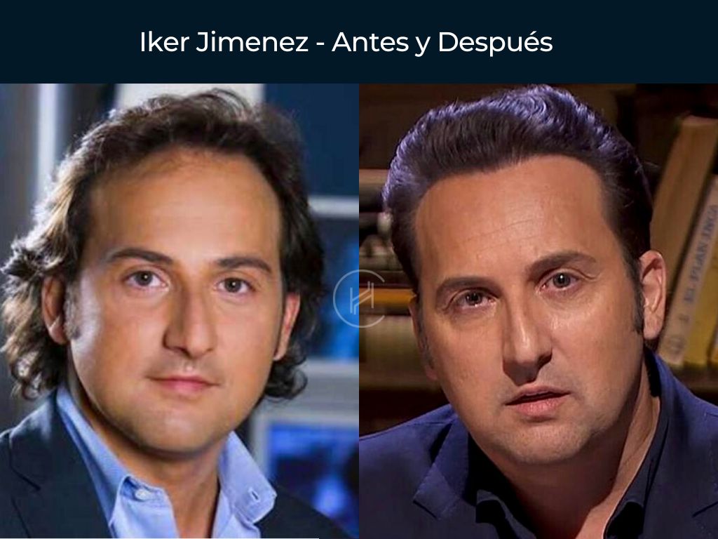 Iker Jimenez - Antes y Después Injerto Capilar