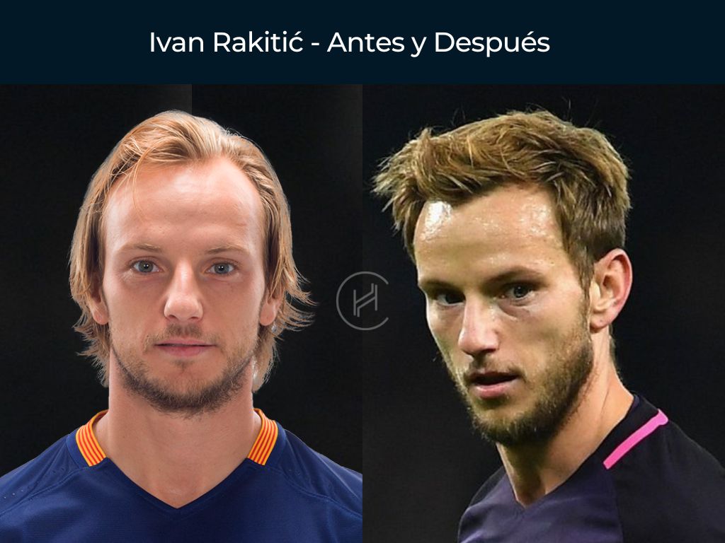 Ivan Rakitić - Antes y Después Injerto Capilar