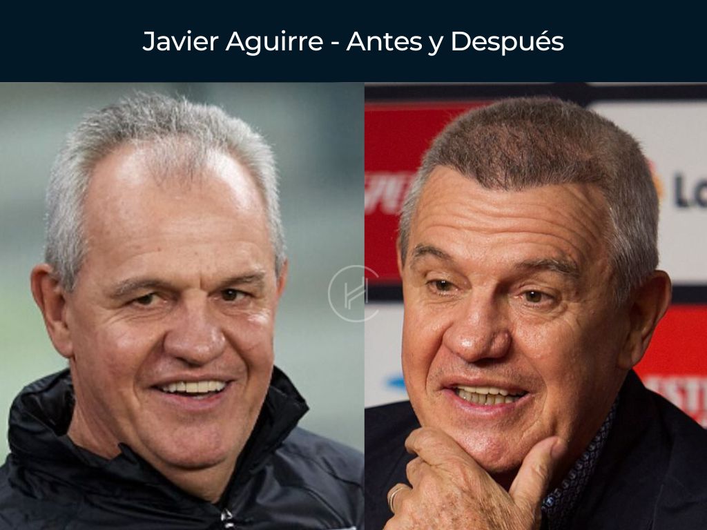 Javier Aguirre - Antes y Después Injerto Capilar